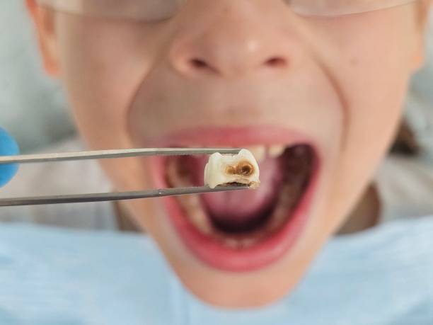 Best Emergency Treatment for Toothache in Shelburne Falls, MA
